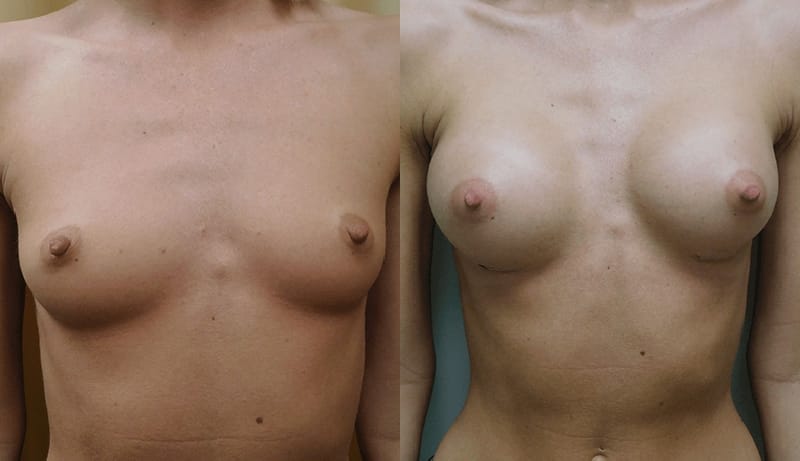 Breast Augmentation Before & After Photos | Rottman Plastic Surgery