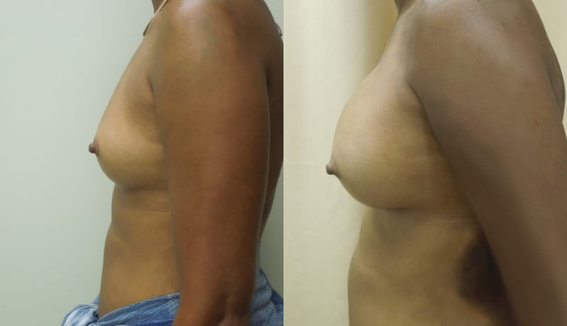 Breast Augmentation Before & After Photos | Rottman Plastic Surgery
