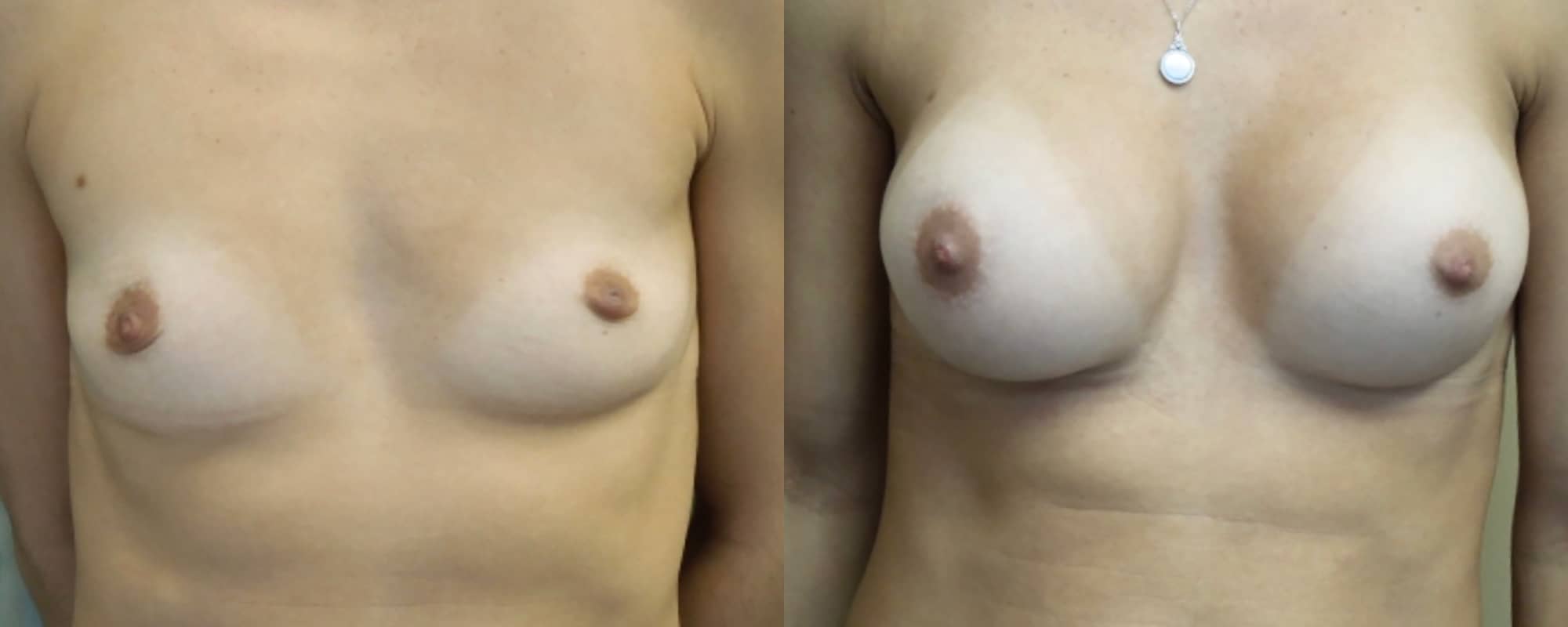 Breast Augmentation Before & After Photos | Rottman Plastic Surgery