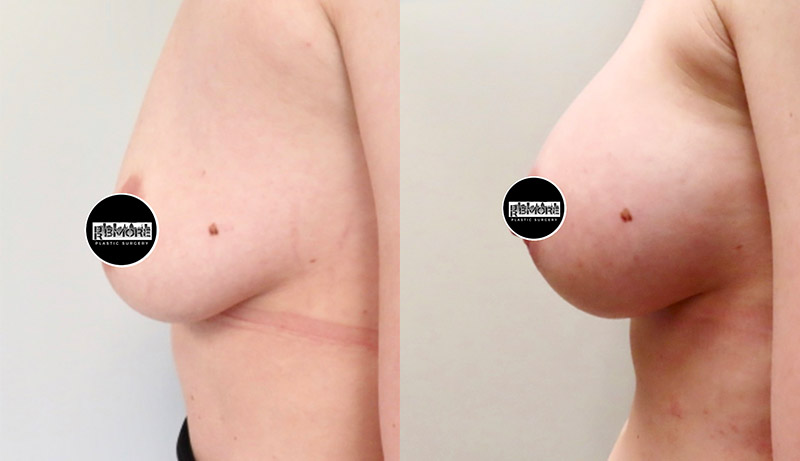 Breast Augmentation Before & After Photos | Rottman Plastic Surgery