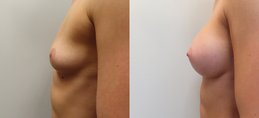 Breast Augmentation Before & After Photos | Rottman Plastic Surgery