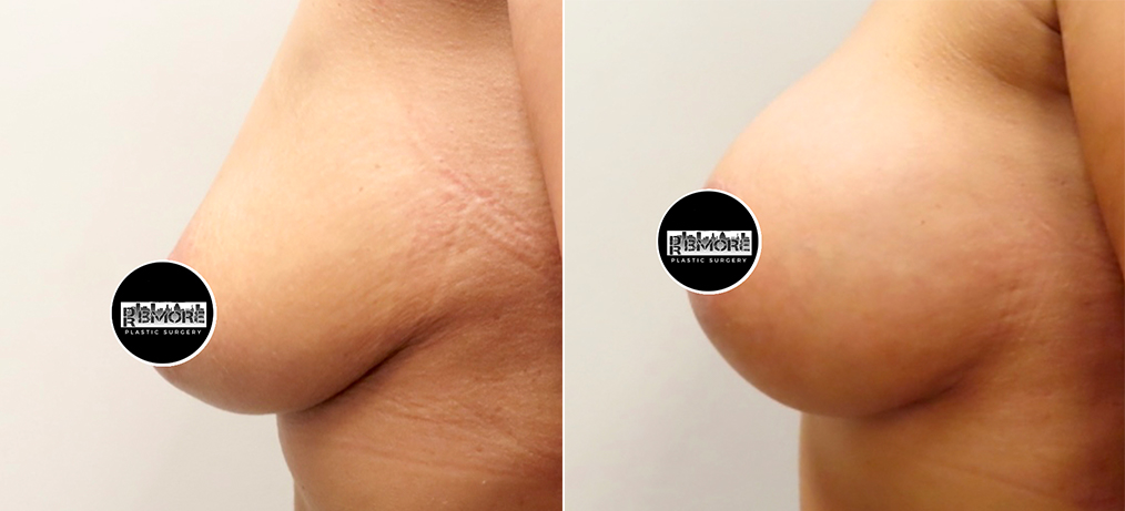 Breast Augmentation Before & After Photos | Rottman Plastic Surgery