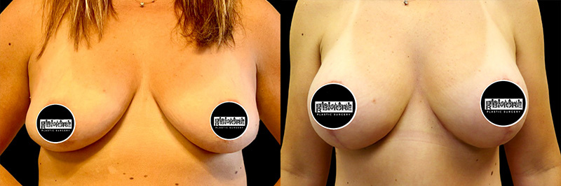 Breast Lift Before & After Photos | Rottman Plastic Surgery