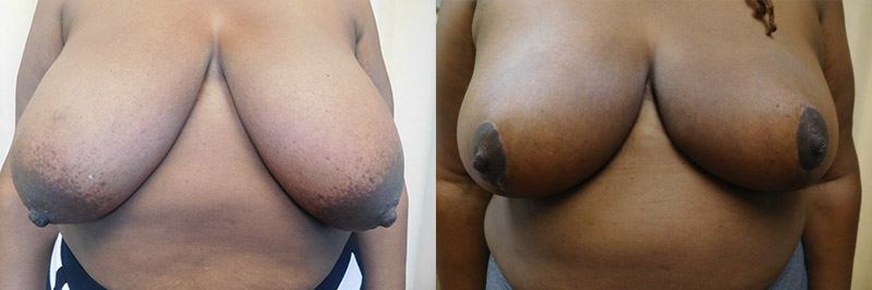 Breast Lift Before & After Photos | Rottman Plastic Surgery
