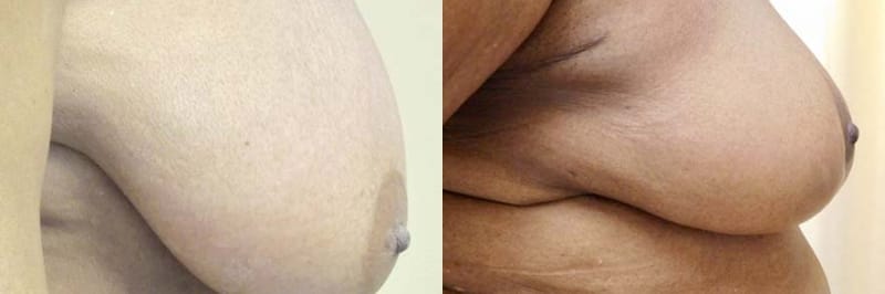 Breast Lift Before & After Photos | Rottman Plastic Surgery