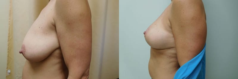 Breast Lift Before & After Photos | Rottman Plastic Surgery
