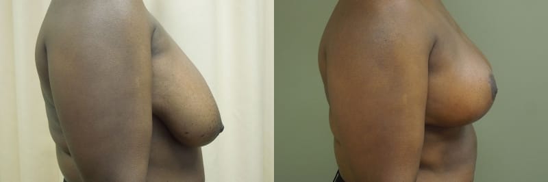 Breast Lift Before & After Photos | Rottman Plastic Surgery