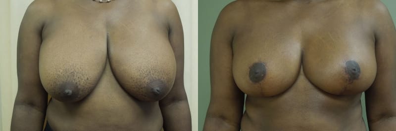 Breast Lift Before & After Photos | Rottman Plastic Surgery