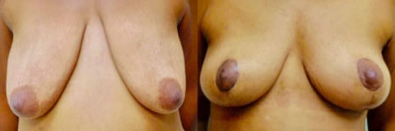 Breast Lift Before & After Photos | Rottman Plastic Surgery