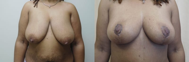 Breast Lift Before & After Photos | Rottman Plastic Surgery