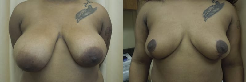 Breast Lift Before & After Photos | Rottman Plastic Surgery
