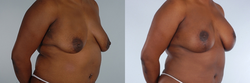Breast Lift Before & After Photos | Rottman Plastic Surgery