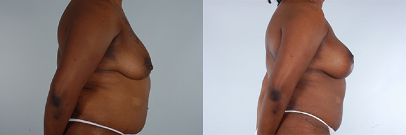 Breast Lift Before & After Photos | Rottman Plastic Surgery