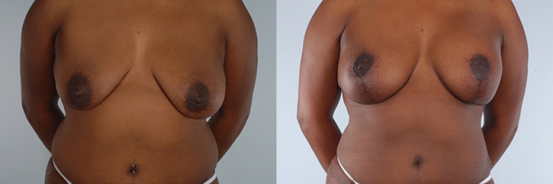 Breast Lift Before & After Photos | Rottman Plastic Surgery