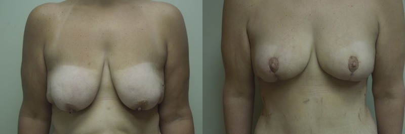 Breast Lift Before & After Photos | Rottman Plastic Surgery