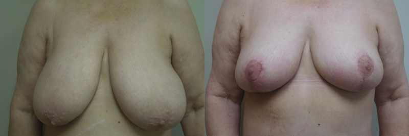 Breast Lift Before & After Photos | Rottman Plastic Surgery
