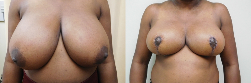 Breast Lift Before & After Photos | Rottman Plastic Surgery