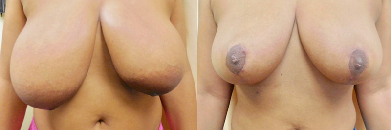 Breast Lift Before & After Photos | Rottman Plastic Surgery