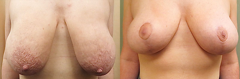 Breast Lift Before & After Photos | Rottman Plastic Surgery