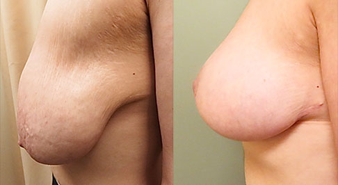 Breast Lift Before & After Photos | Rottman Plastic Surgery