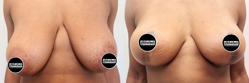 Breast Lift Before & After Photos | Rottman Plastic Surgery
