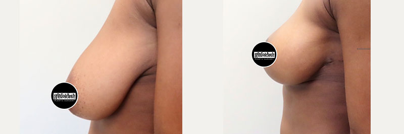 Breast Lift Before & After Photos | Rottman Plastic Surgery