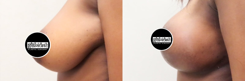 Breast Lift Before & After Photos | Rottman Plastic Surgery