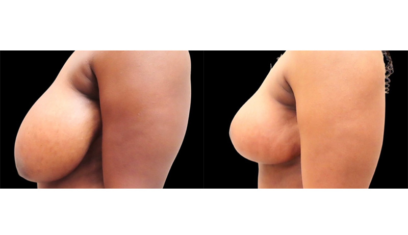 Breast Reduction Before & After Photos | Rottman Plastic Surgery