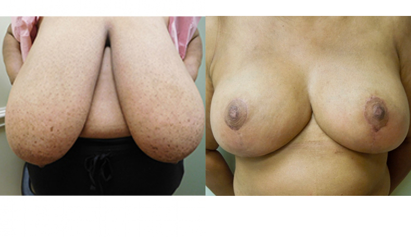 Breast Reduction Before & After Photos | Rottman Plastic Surgery