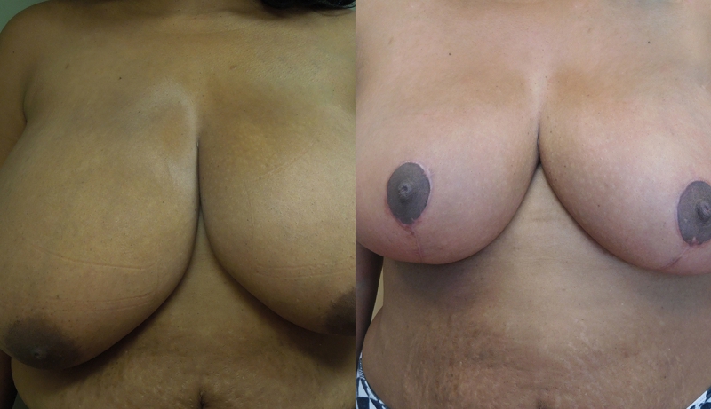 Breast Reduction Before & After Photos | Rottman Plastic Surgery