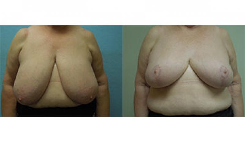 Breast Reduction Before & After Photos | Rottman Plastic Surgery