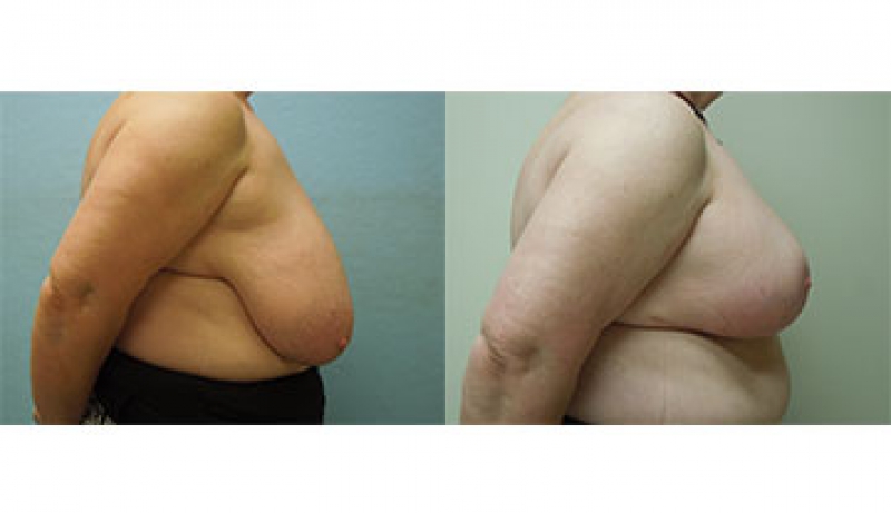 Breast Reduction Before & After Photos | Rottman Plastic Surgery