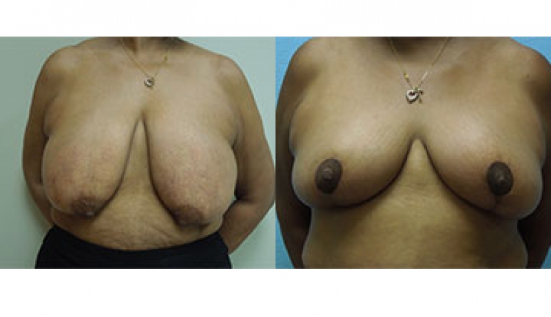 Breast Reduction Before & After Photos | Rottman Plastic Surgery