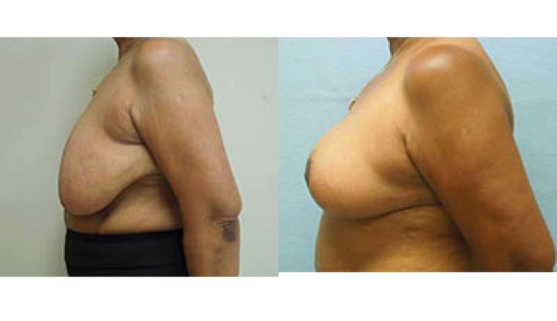 Breast Reduction Before & After Photos | Rottman Plastic Surgery