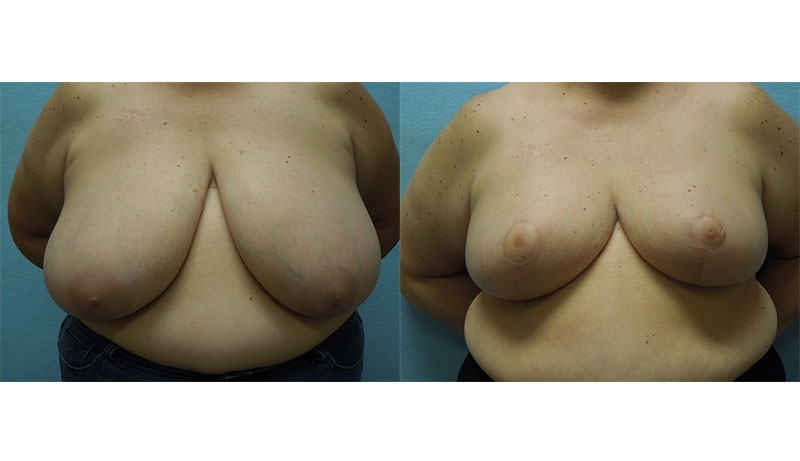 Breast Reduction Before & After Photos | Rottman Plastic Surgery
