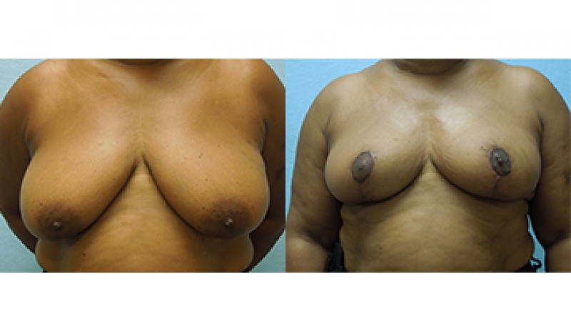 Breast Reduction Before & After Photos | Rottman Plastic Surgery