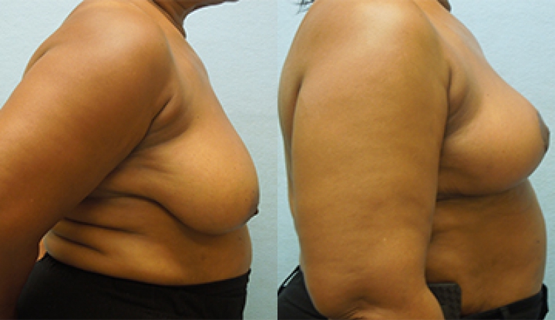 Breast Reduction Before & After Photos | Rottman Plastic Surgery