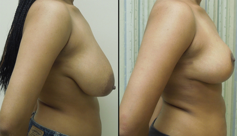 Breast Reduction Before & After Photos | Rottman Plastic Surgery