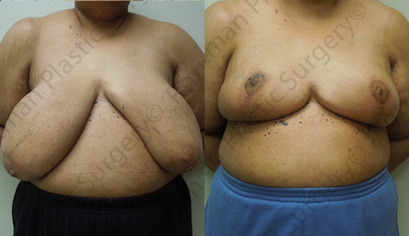 Breast Reduction Before & After Photos | Rottman Plastic Surgery