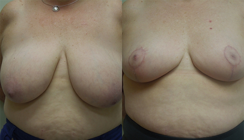 Breast Reduction Before & After Photos | Rottman Plastic Surgery