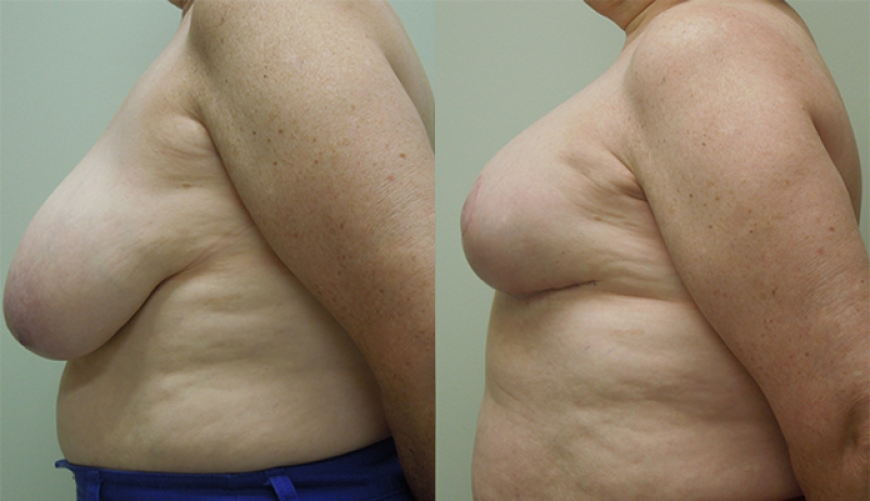 Breast Reduction Before & After Photos | Rottman Plastic Surgery