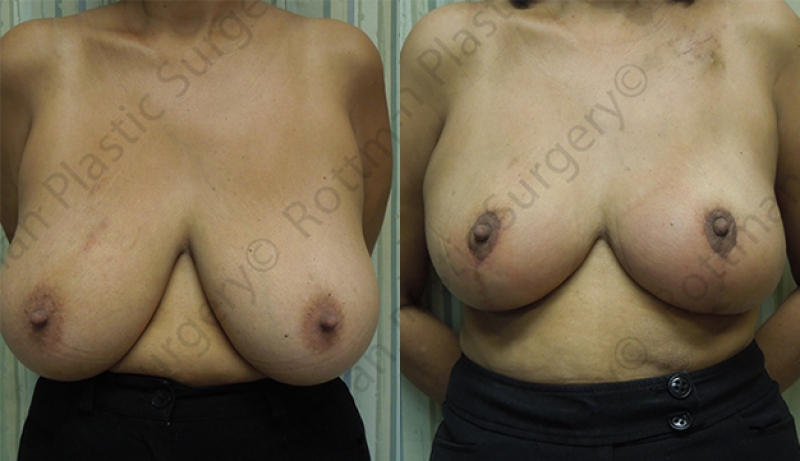 Breast Reduction Before & After Photos | Rottman Plastic Surgery