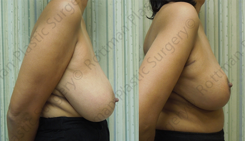 Breast Reduction Before & After Photos | Rottman Plastic Surgery