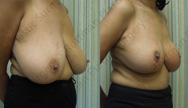 Breast Reduction Before & After Photos | Rottman Plastic Surgery
