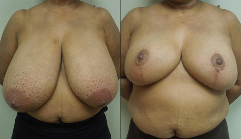 Breast Reduction Before & After Photos | Rottman Plastic Surgery