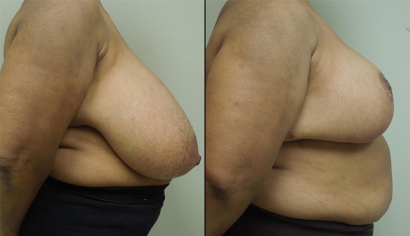 Breast Reduction Before & After Photos | Rottman Plastic Surgery