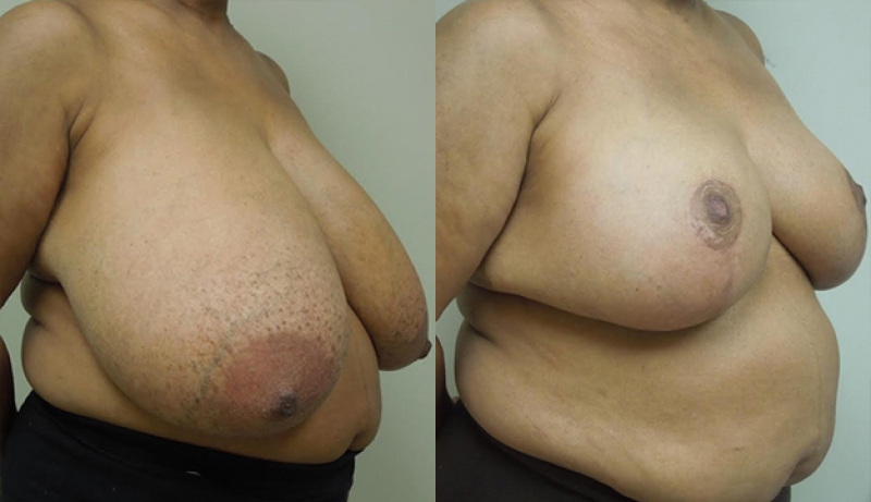 Breast Reduction Before & After Photos | Rottman Plastic Surgery