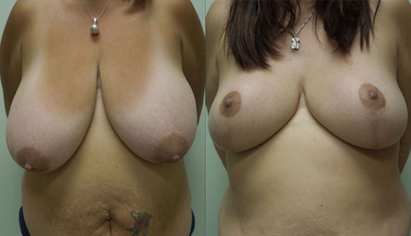 Breast Reduction Before & After Photos | Rottman Plastic Surgery