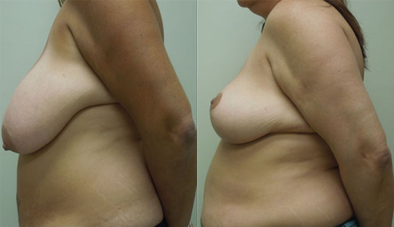 Breast Reduction Before & After Photos | Rottman Plastic Surgery