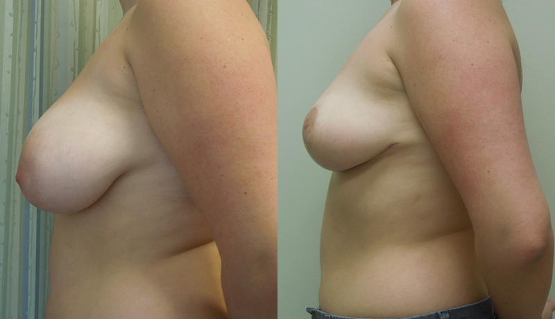 Breast Reduction Before & After Photos | Rottman Plastic Surgery